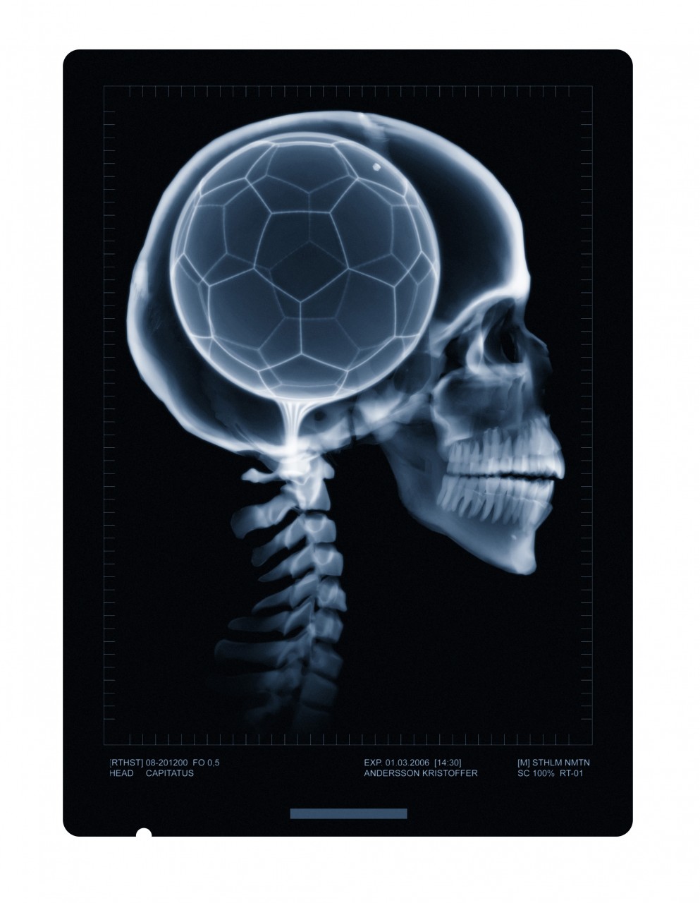 X ray scull with football brain skeleton skelett skalle med fotboll tänder nacke tand ben